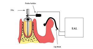 apex locator ppt|An overview of electronic apex locators: part 1 .